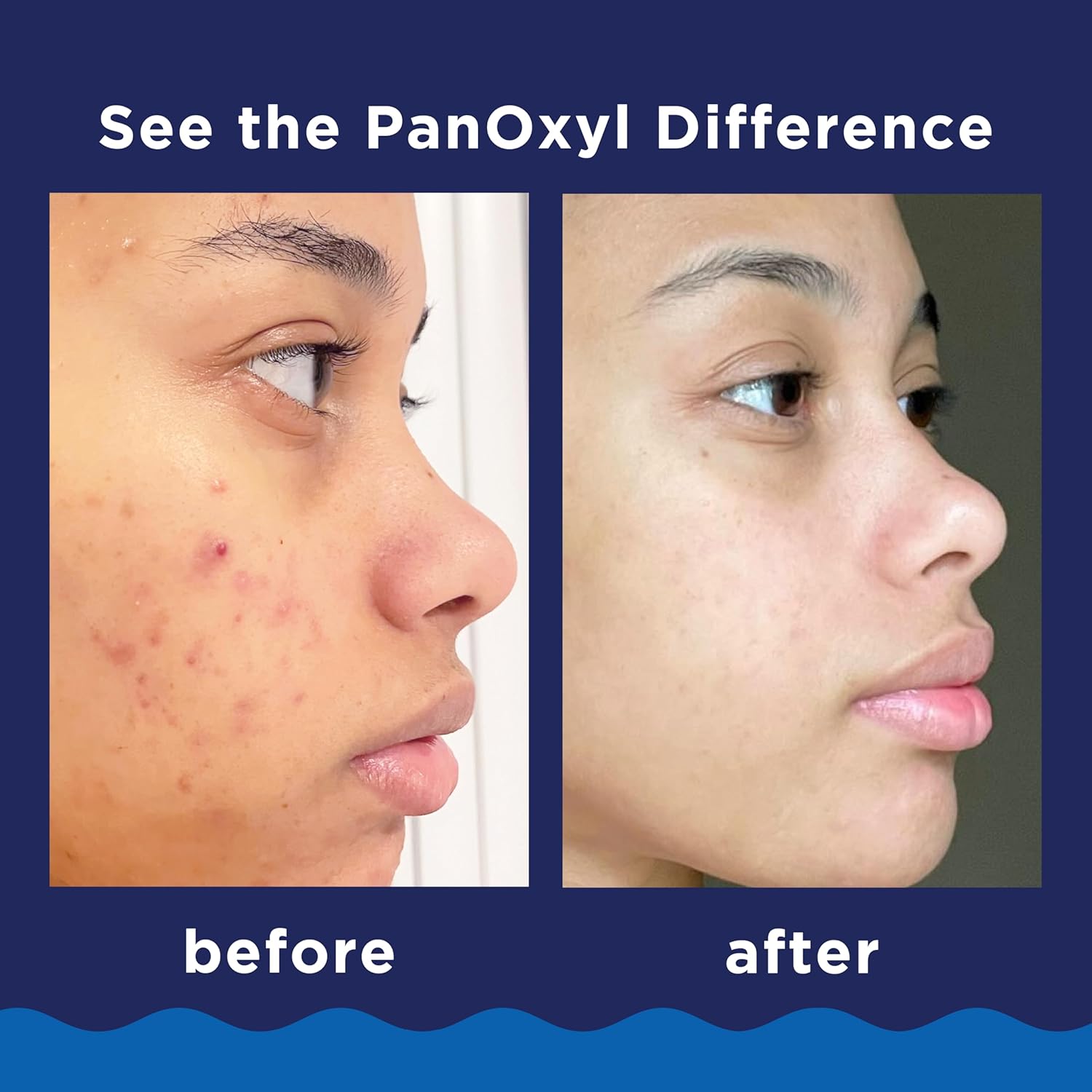 PanOxyl Acne Foaming Wash Max Strength