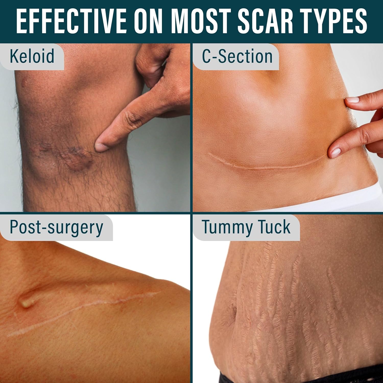 NUVADERMIS Silicone Scar Tape for Surgical Scars