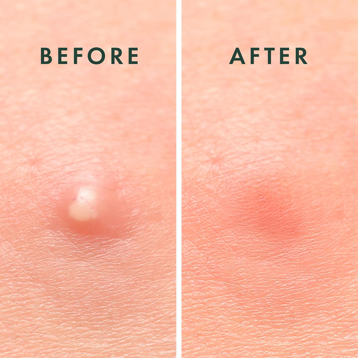 Rael Pimple Patches Invisible Hydrocolloid
