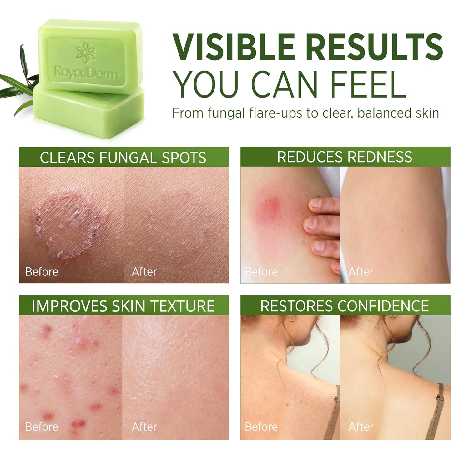 Roycederm Antifungal Tea Tree Soap for Acne